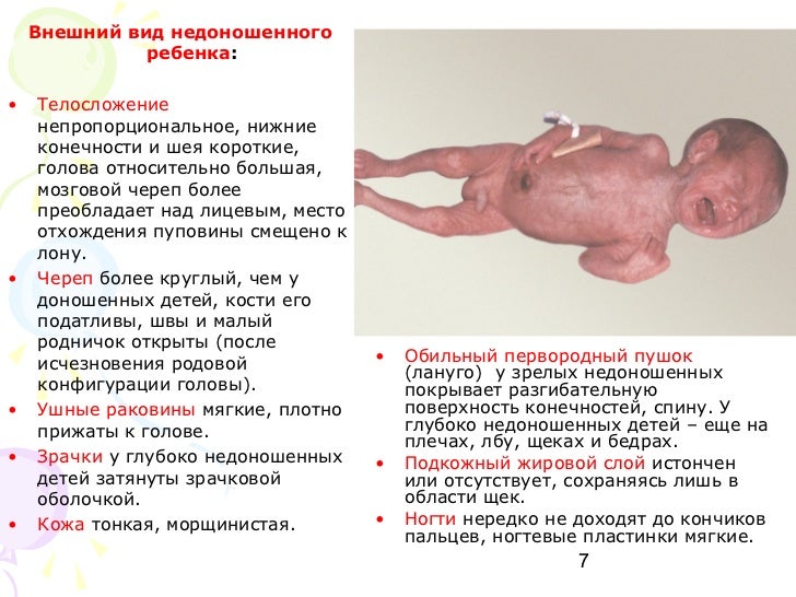 Доношенный и недоношенный ребёнок: отличия Доношенный и недоношенный ребёнок: отличия